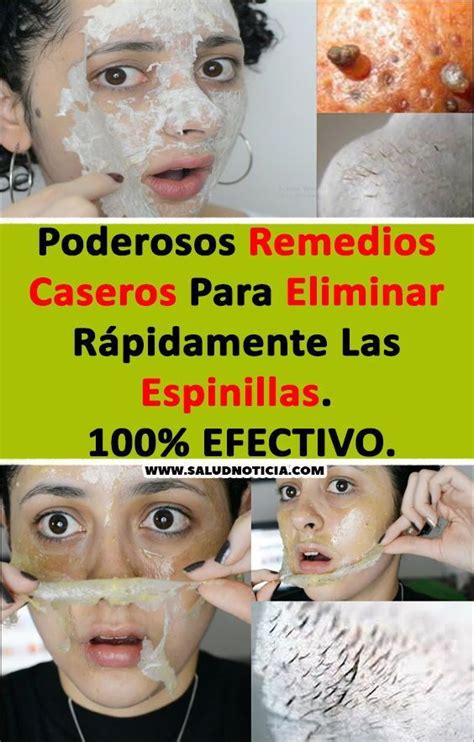 Remedio Casero Para Eliminar Las Espinillas Y Manchas De La Cara Home