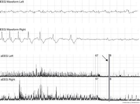 Clinical Utility Of Early Amplitude Integrated Eeg In Monitoring Term