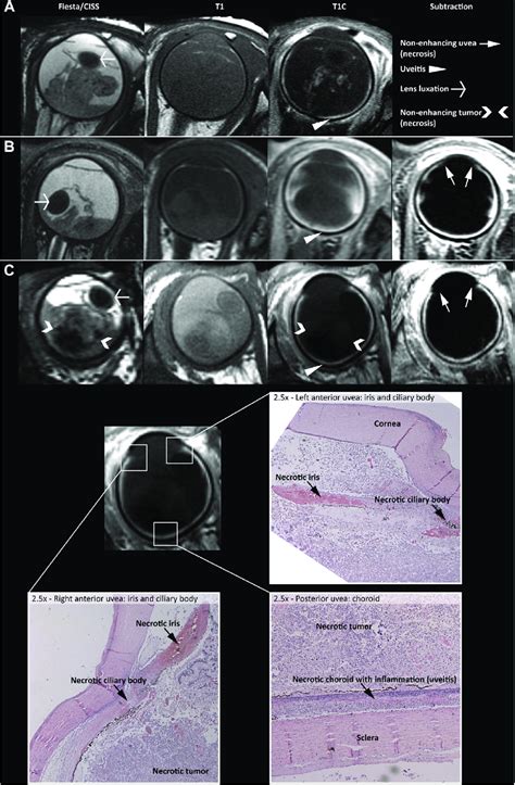 Intraorbital Findings Of Retinoblastoma With Orbital Cellulitis A And