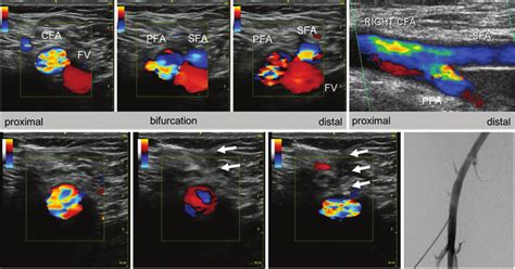 Femoral Artery Access