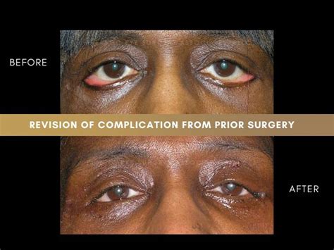 Lower Blepharoplasty Gone Wrong