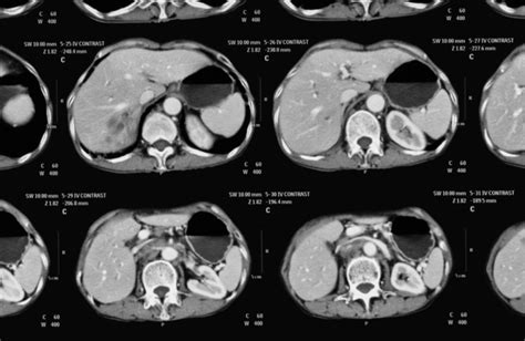 Hepatic Adenoma Liver Lesions