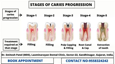 Tooth Decay Stages and How to Treat Each? - Laxmi Narayan ...