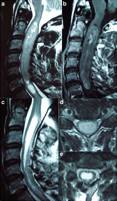 Intramedullary Ependymoma WHO II C2 To C6 The Tumor Was Removed En