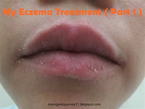 eczema on lip - pictures, photos