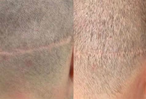 Before And After Scar Repair, 34 years old male, 200 grafts - Toronto ...