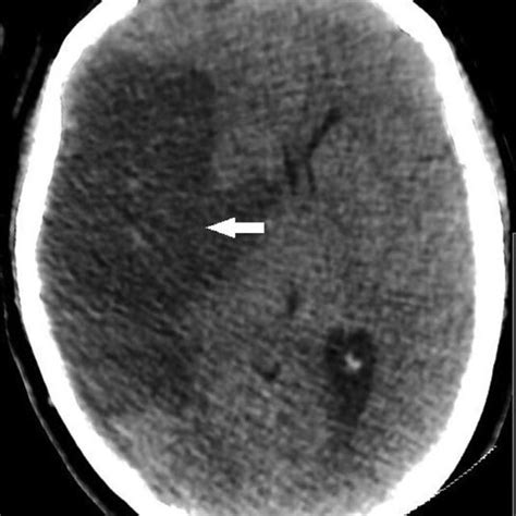 Ct Of The Head Axial Plane Showing Right Hemispheric Ischemia With Download Scientific