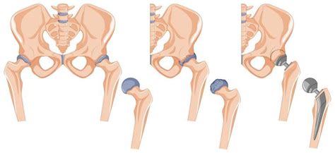 Choosing A Surgeon For Total Hip Replacement Surgeon In Thane Revival