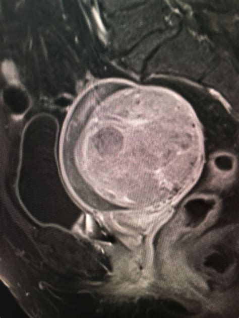 Fibroid with degeneration