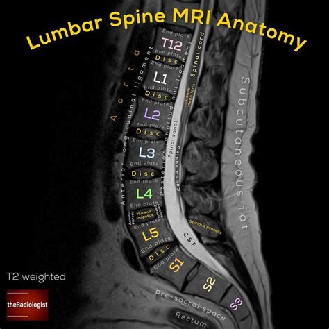 Sagittal T2 weighted image of an MRI of the lumbar spine ⁣ ⁣ LUMBAR ...