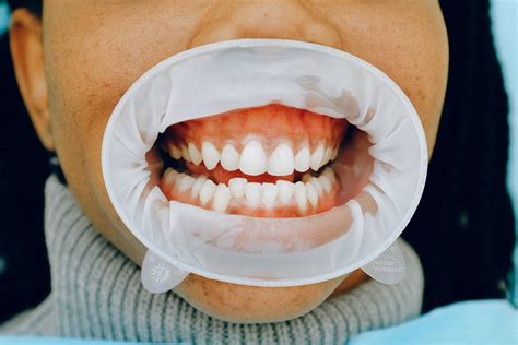 Gummy Smile: What To Do? Treatment Options - Medic istanbul