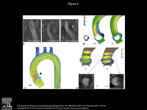 Restricted Cusp Motion In Right Left Type Of Bicuspid Aortic Valves A