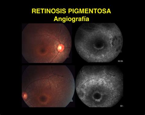 Retinosis Pigmentosa Somos Retina Y M Cula Consultores