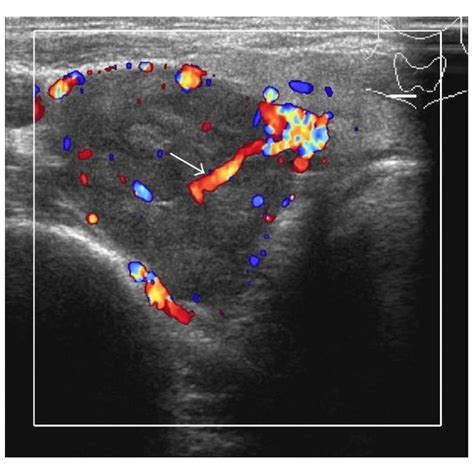 Ultrasonogram Of Thyroid Gland And Parathyroid Glands A