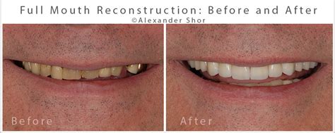 Full Mouth Reconstruction Before And After Seattle Shor Dental