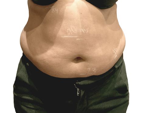 Fat Freezing Treatment | Non-Surgical Liposuction London | HC MedSpa