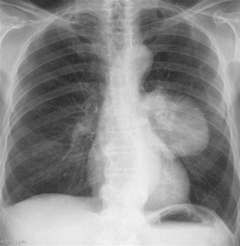 Cloudy lung x ray. Cloudy Lung X-Ray: Understanding Chest X-Ray ...