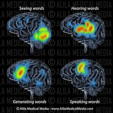 PET scan of brain during speech | Brain scan, Pet scan, Mri brain