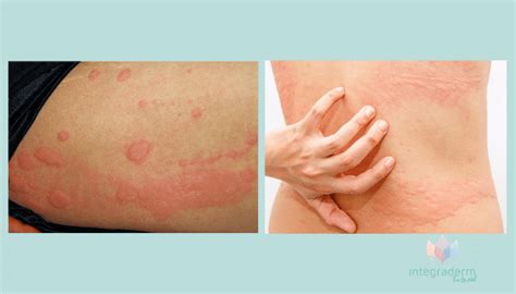 Urticaria Crónica Espontánea Causas Y Tratamiento