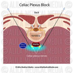 Prestige Pain Centers - Celiac Plexus Nerve Block