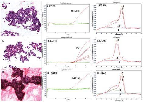 Application Of PCR Methods To Evaluate EGFR KRAS And BRAF Mutations In