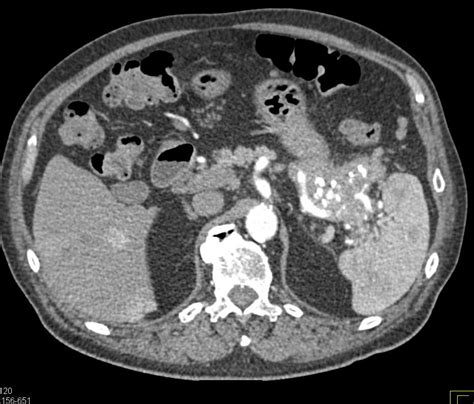 Pancreatic Neuroendocrine Tumor Pnet Tail Of Pancreas Pancreas Case