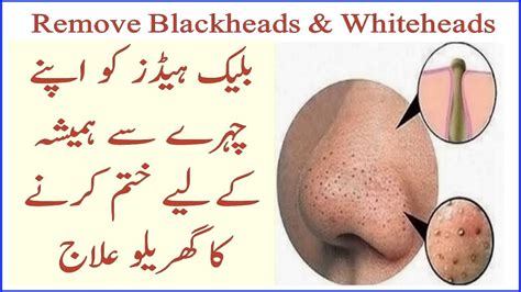 Blackheads Khtam Karny Ka Gharelu Ilaj 100 Results YouTube