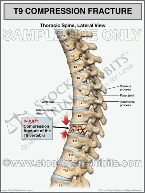 Compression Fracture Treatment Causes Symptoms 42 Off