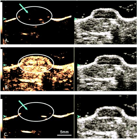 Making Waves How Ultrasound Targeted Drug Delivery Is Changing