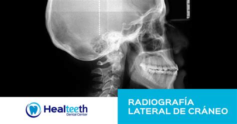 Anatomía De La Radiografía Lateral Del Cráneo Ap Lateral De Craneo
