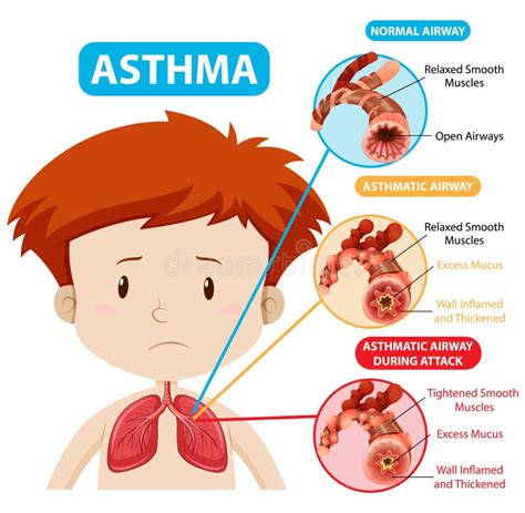 Asthma Clip Art Stock Illustrations – 210 Asthma Clip Art Stock ...