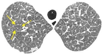 Reticular Opacities | Radiology Key