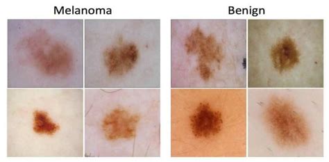 Various dermoscopy image types for melanoma and benign. | Download ...