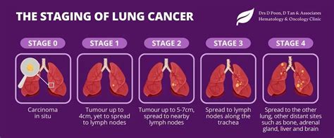 A Patients Guide To Lung Cancer Prevention And Treatment In Singapore By Medical Oncologist Dr