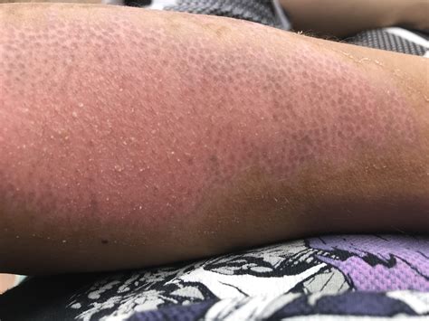 The color of my skin returns in circles : r/mildlyinteresting