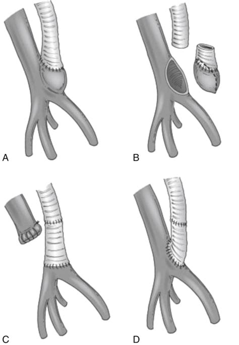 Surveillance Of Lower Extremity Bypass Grafts Thoracic Key