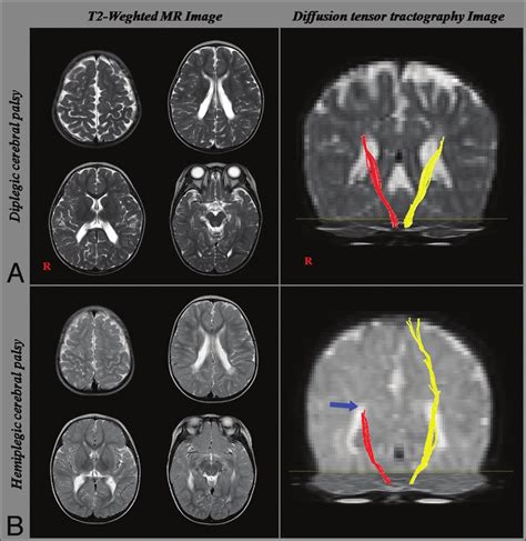 Results Of Conventional Mr Imaging And Dtt A Conventional Mr Images