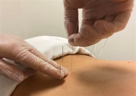 Dry Needling Understanding The Benefits Lacasadejara