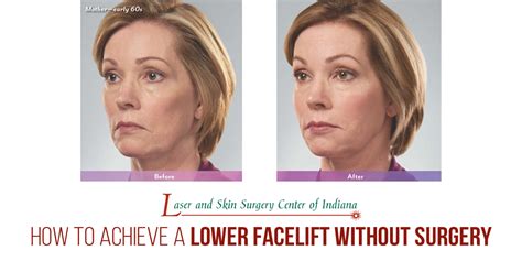 Achieve A Lower Facelift Without Surgery The Laser And Skin Surgery