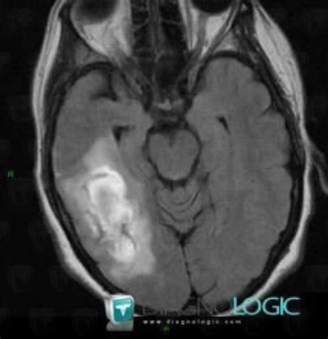 Radiology case : Contusion (CT ,MRI) - Diagnologic