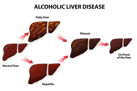 Liver Damage 7 Important Signs Of Liver Damage