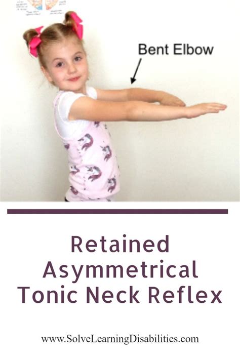 Asymmetric Tonic Neck Reflex