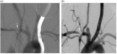 A Intravenous Digital Subtraction Angiography Iv Dsa At One Month