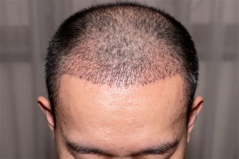 Different Fue Hair Transplant Techniques Which One Is An Ideal Option