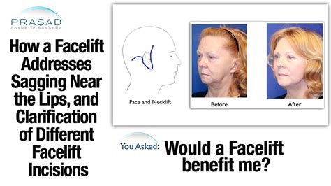 How A Facelift Treats Marionette Lines And Clarifying Facelift