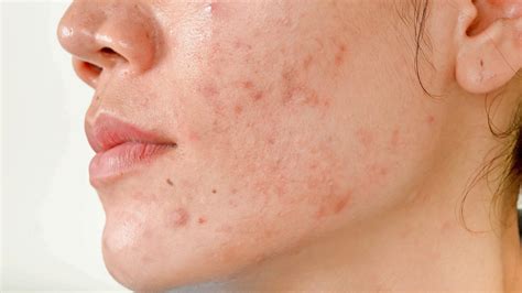 Guia Completo Cicatriz De Acne Como Preveni Las Causas E Tratamento