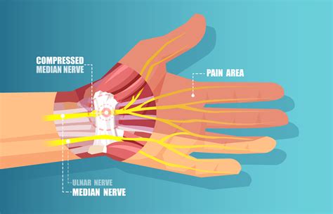 Winning The Battle Of Compressed Nerves And Neuropathic Pain