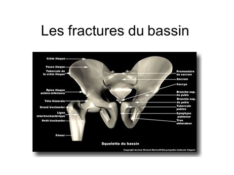 Les Fractures Du Bassin Pdf Etude Az