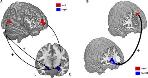 Structural Covariance Results A RGMV In The VmPFC And PSTS Seed