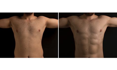 PAL High Definition Liposuction For Men Formation